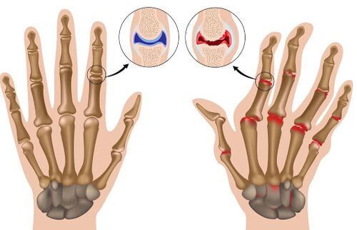 Inflammatory diseases of the joints and their manifestations