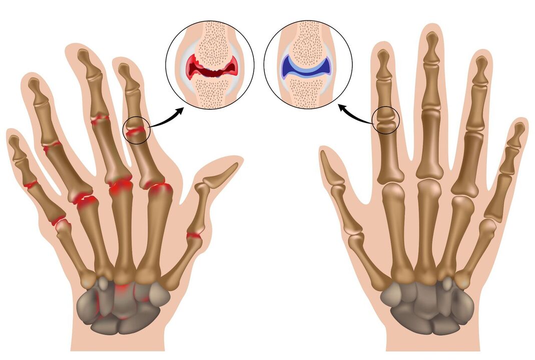 Healthy hand joints and affected by polyarthritis