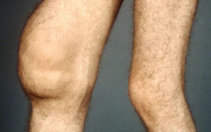 Post -trauma arthrosis from the knee joint