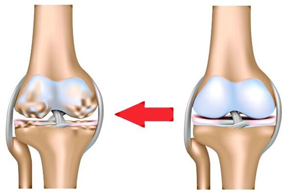 Healthy joints and arthrosis