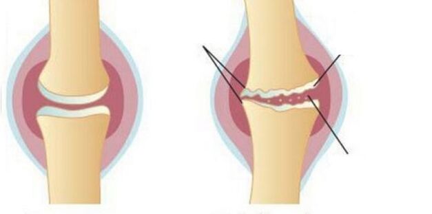 Wash cartilage