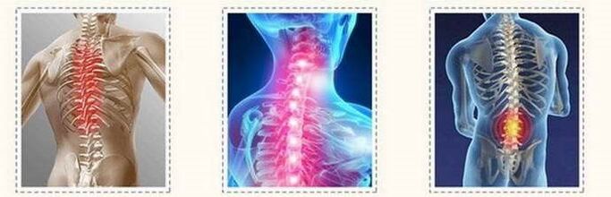 Osteochondrosis spine lesion