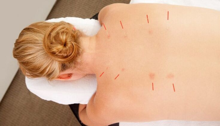 Acupuncture for thoracic osteochondrosis has many advantages